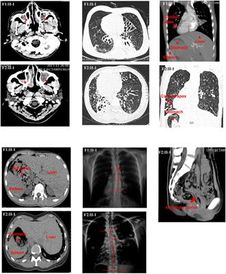 Case Report: DNAAF4 Variants Cause Primary Ciliary Dyskinesia and Infertility in Two Han Chinese Families